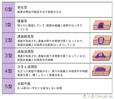 スキルス胃がんって、どんな病気？とは！？