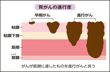 見つけにくく、若年でも発症―スキルス胃がん 定期検査で早期発見を