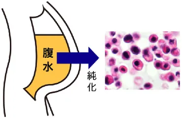 スキルス胃がんの遺伝子異常を特定し新治療に光明 国立がん研究センターと慶大 