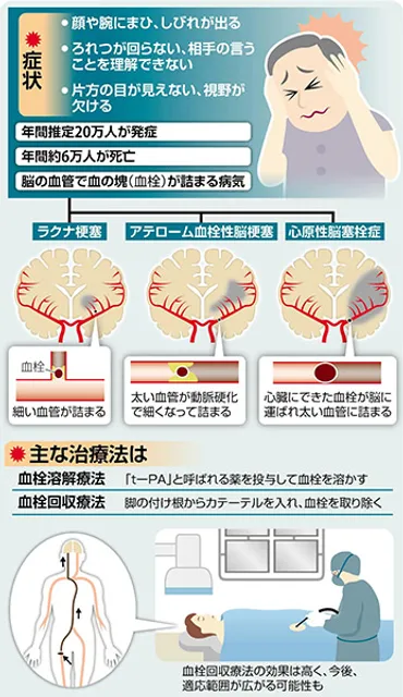 サウナは脳梗塞に良い？それとも悪い？健康メリットとリスクを徹底解説
