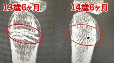 骨端線が閉じる」と身長の関係を解決