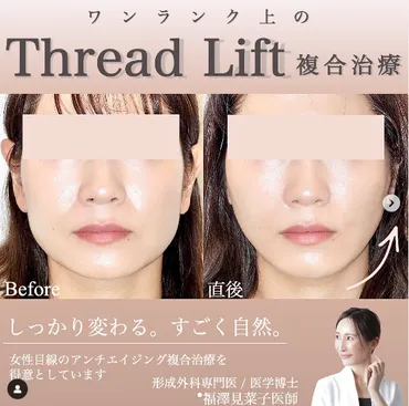 糸リフトの費用