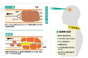脳梗塞のタイムリミット 血管内治療で復帰確率向上