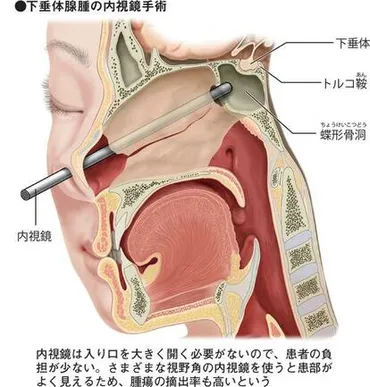 ガンバレルーヤよしこが患った「下垂体腺腫」 視力低下、視野が欠けるなどの症状も